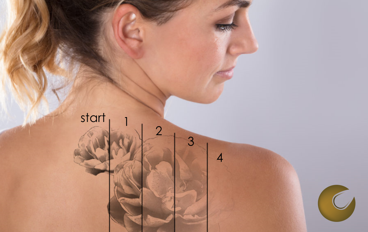 website-tattoo verwijderen
